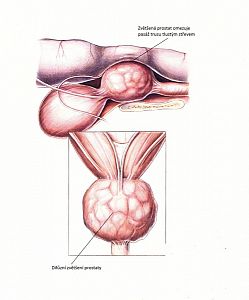 Onemocnění prostaty