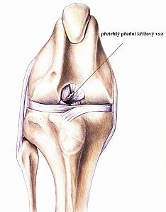 Ruptura předního zkříženého vazu (LCC)